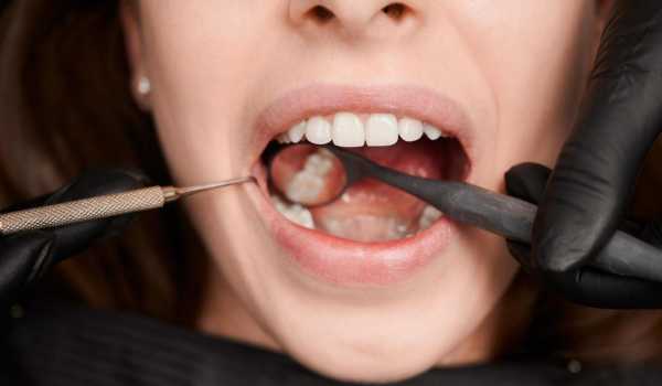 7 причин, через які розвивається карієс (і як помітити його вчасно)